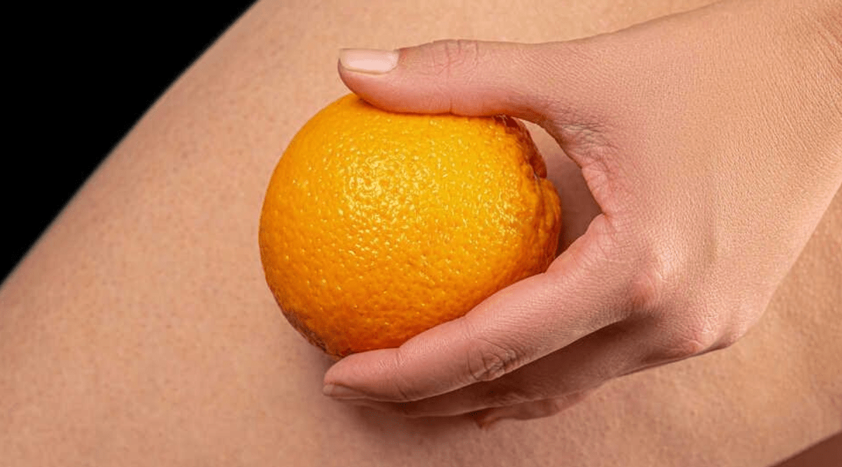 Tipi e stadi di cellulite: come curarla? Immagini dei vari stadi - fgm04